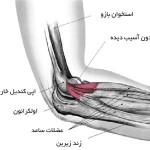 آسیب دیدگی آرنج در ورزشهای راکتی